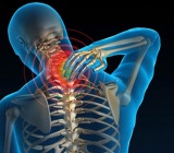 Phục hồi chức năng thoái hóa cột sống cổ 