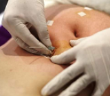 Châm cứu cấy chỉ giảm cân cho bệnh nhân béo bụng tại nhà