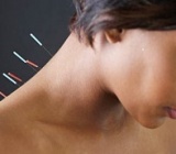 Châm cứu điều trị vẹo cổ cấp tính 